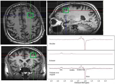 Left Dorsolateral Prefrontal Cortex Glx/tCr Predicts Efficacy of High Frequency 4- to 6-Week rTMS Treatment and Is Associated With Symptom Improvement in Adults With Major Depressive Disorder: Findings From a Pilot Study